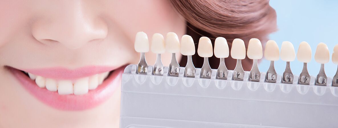 Bleaching - Zahnaufhellung in der Zahnarztpraxis Dr. Leonardo Dude in Bad Homburg